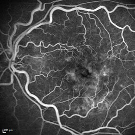 Fluoreszenzangiographie, Augenarzt München, Augenarztpraxis Prof. Marcus Kernt & Kollegen